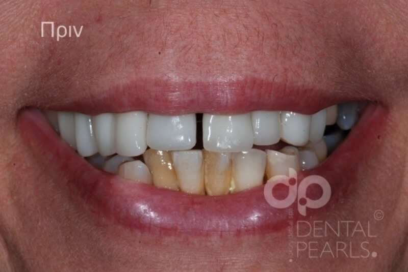 odontika emfyteymata before after dental pearls