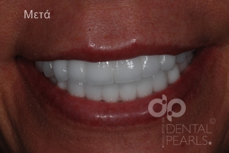 odontika emfyteymata before after dental pearls