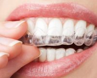 Teeth cleaning and whitening, for healthy and bright teeth