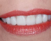 Resin or Porcelain Veneers? Advantages and characteristics